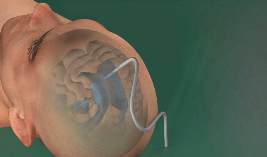 Swiss MedTech startup Rhovica raises €2.5 million for emergency neurosurgical device